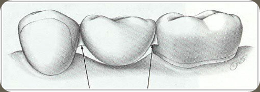 dental crown photo