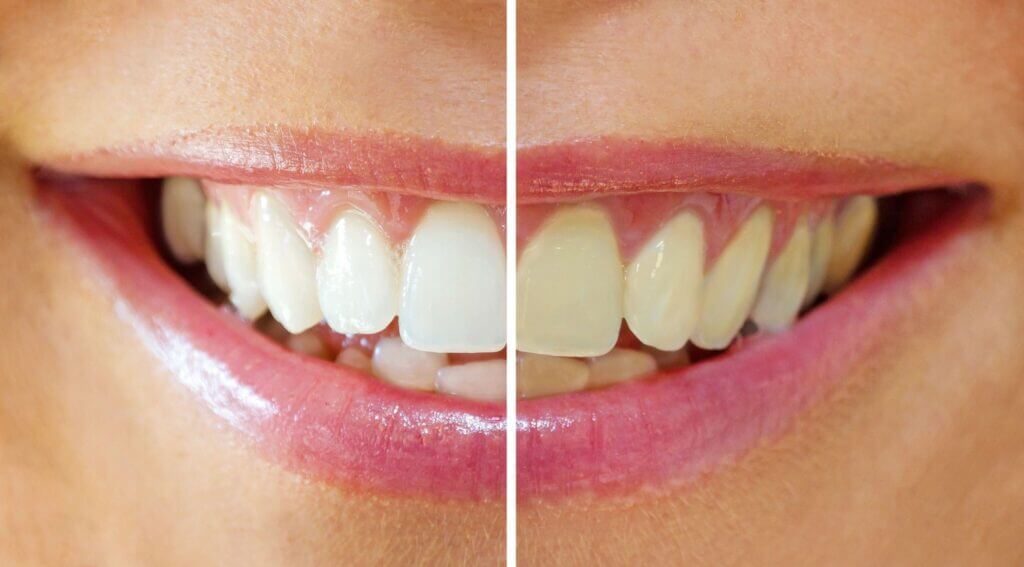 Side by side teeth comparison. Before and after shot