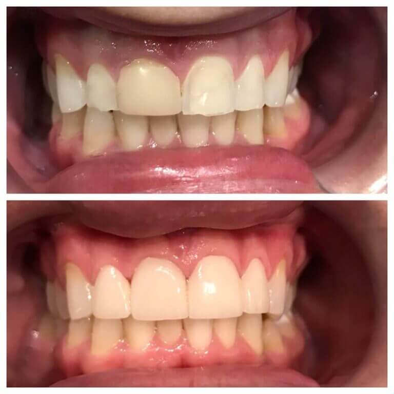 Before/After Photo of Teeth