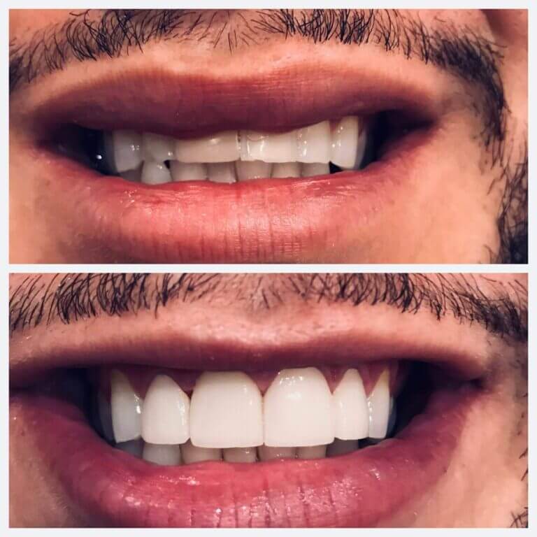 Before/After Photo of Teeth